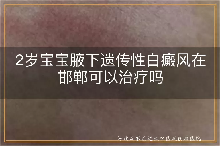 2岁宝宝腋下白斑能治吗,儿童腋下白癜风邯郸治疗,幼儿遗传性白斑怎么处理,宝宝腋下有白斑遗传吗,邯郸小孩腋下白癜风能看好吗
