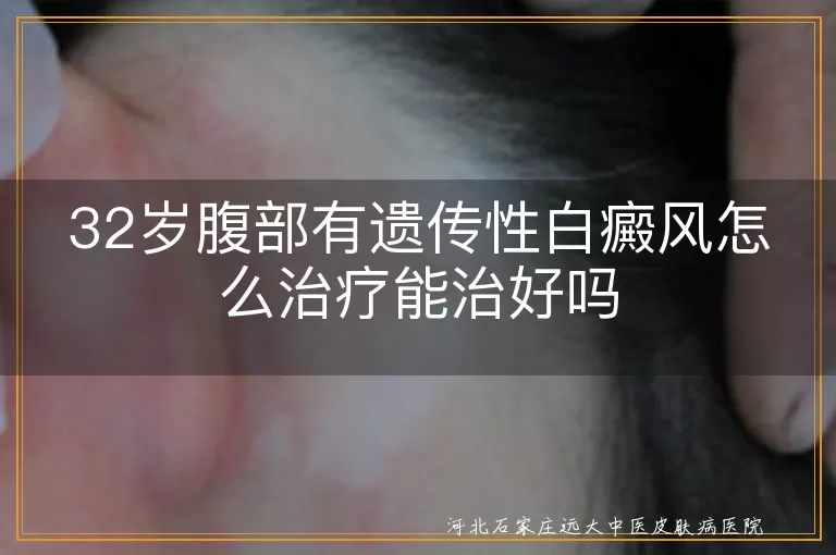 腹部遗传性白癜风32岁能治好吗,32岁腹部白斑遗传性怎么治疗好,32岁遗传性白癜风在腹部能治好吗