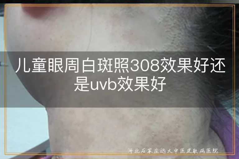 儿童眼周白斑308治疗,儿童眼周白斑uvb治疗,儿童眼周白斑照光哪种好,儿童眼部白斑308效果,儿童眼处白斑照光选择