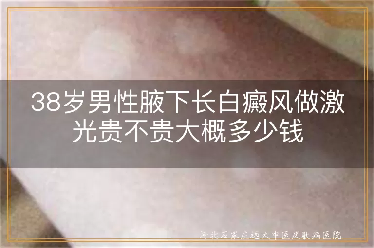 腋下白癜风激光费用,38岁男性白斑激光贵不贵,腋下白斑做激光多少钱