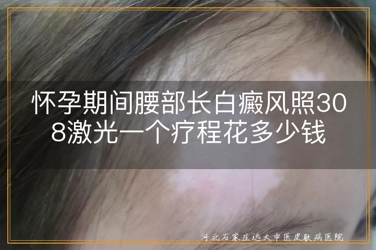 怀孕期间腰部长白癜风照308激光一个疗程花多少钱