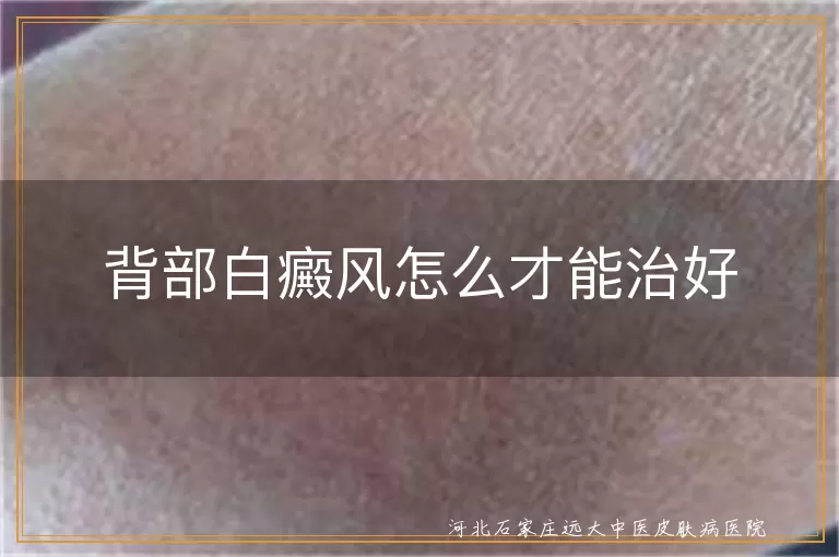 背部白斑怎么消除效果好,背部白癜风如何有效复色,后背长白斑怎么治疗恢复快