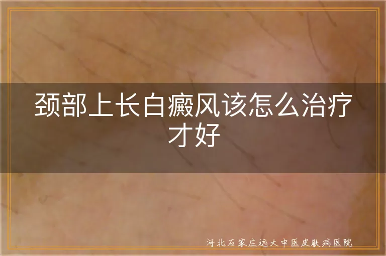 颈部上长白癜风怎么治,脖子上长白斑怎么办,颈部白癜风治疗的好方法