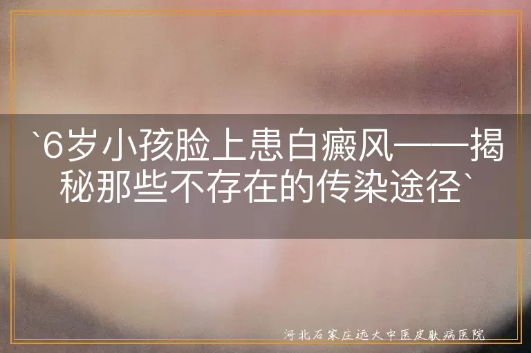 白癜风,传染性,儿童,遗传,自身免疫系统疾病,日常护理,心理健康
