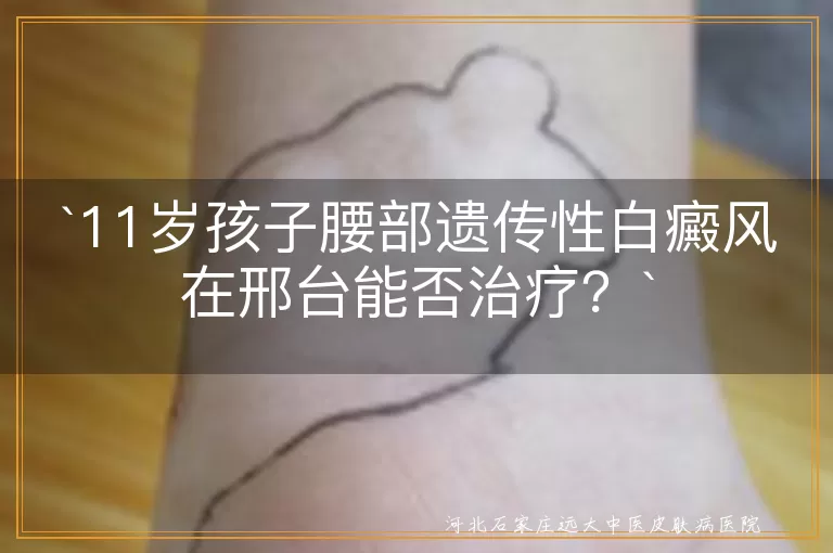 遗传性白癜风,邢台白癜风医院,个性化治疗,科学规范,儿童白癜风,心理关怀