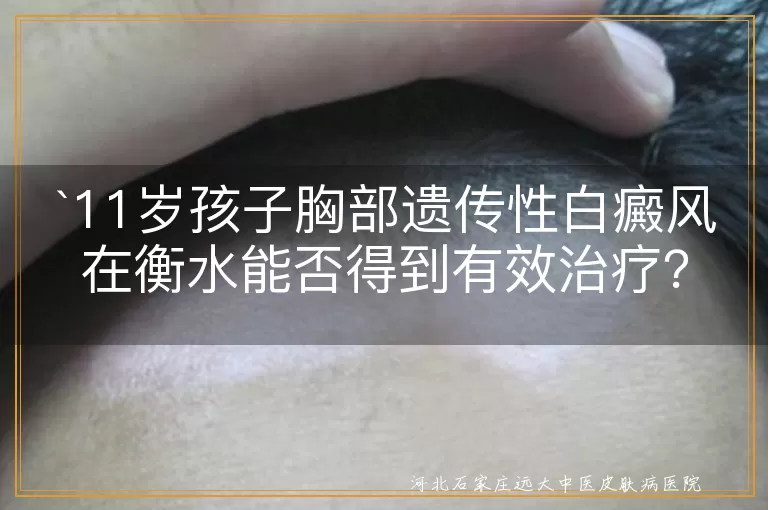 遗传性白癜风,石家庄治疗,个性化治疗方案,药物治疗,光疗,手术治疗,心理治疗,家长应对