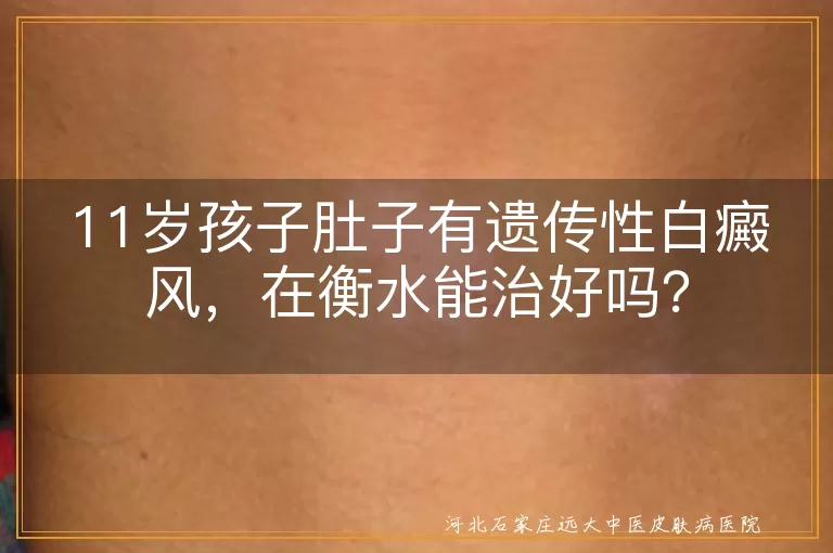 遗传性白癜风,石家庄治疗,儿童白癜风,专业医院,综合治疗,心态调节,饮食均衡