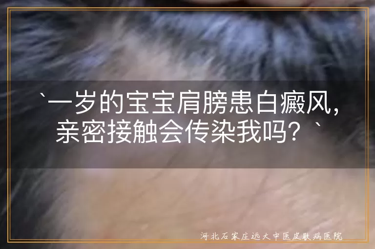 白癜风,传染病,亲密接触,宝宝,心理健康,治疗护理