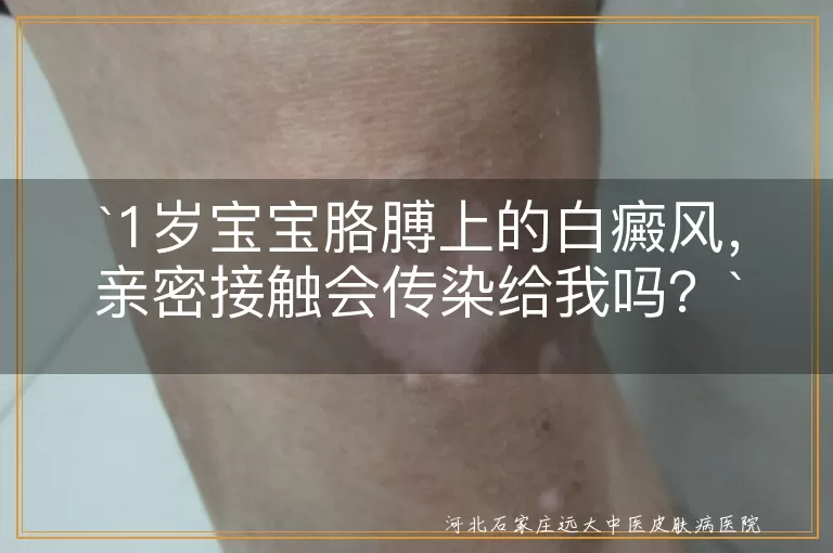 `白癜风,亲密接触,传染,宝宝,治疗,护理`