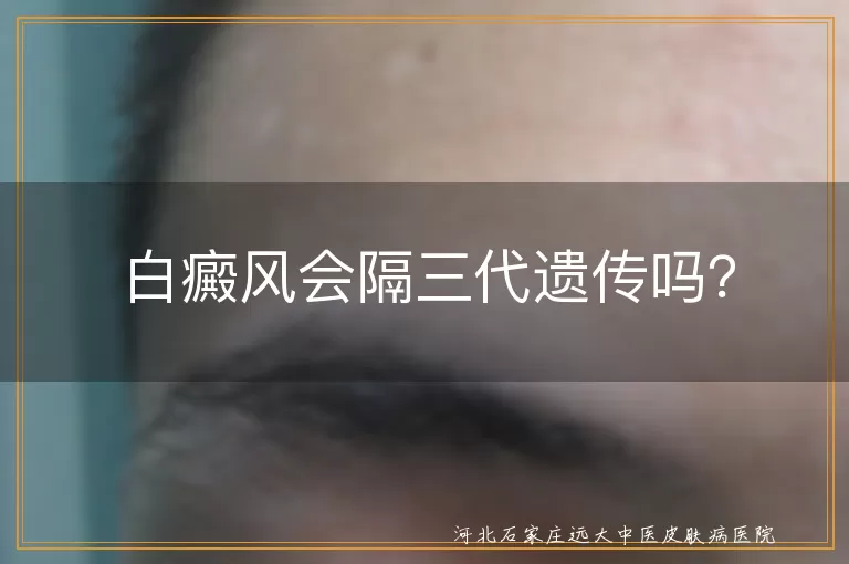 白癜风,遗传,家族聚集性,环境因素,预防控制
