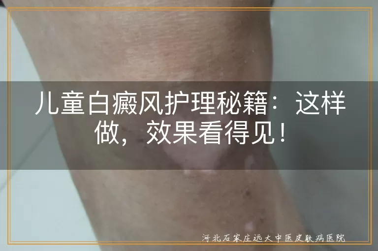 儿童白癜风护理秘籍：这样做，效果看得见！