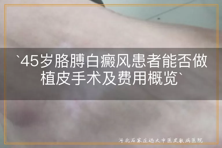 白癜风,植皮手术,费用,正规医院,个人病情,手术难度,地区消费水平