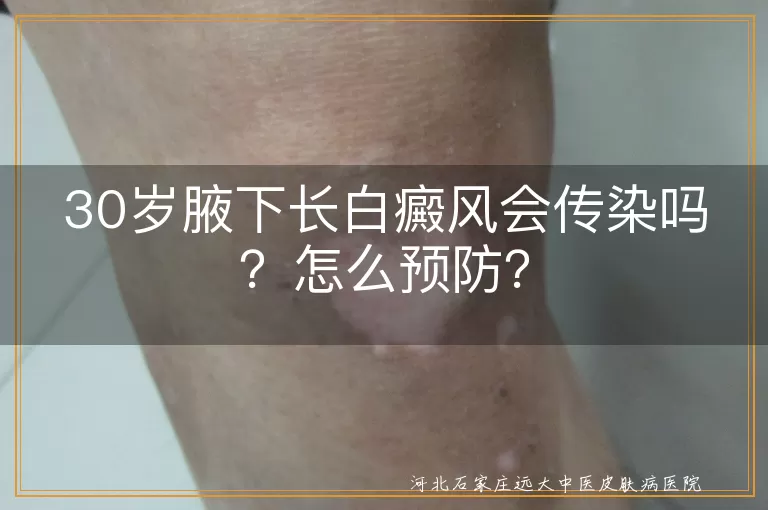 白癜风,传染,预防,合理饮食,防晒,心态,生活习惯