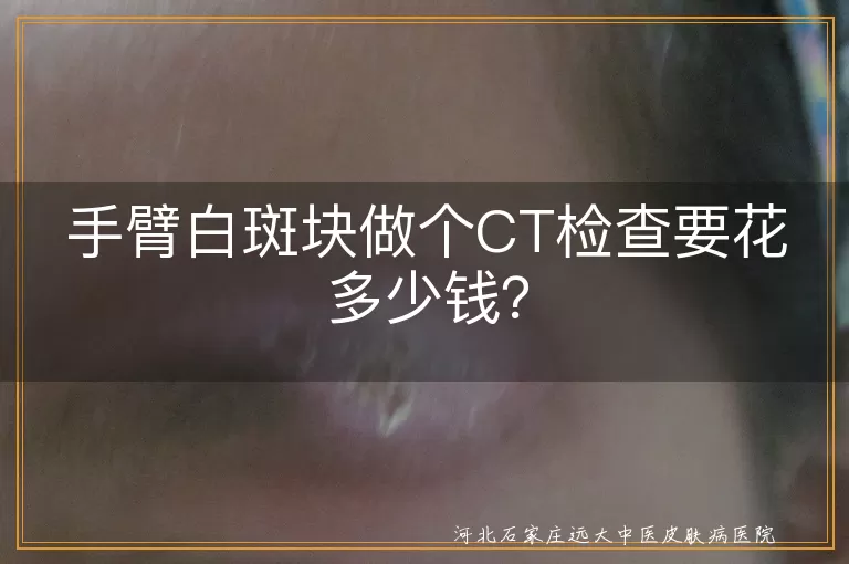 手臂白斑块,CT检查,伍氏灯,皮肤镜,费用差异,健康检查