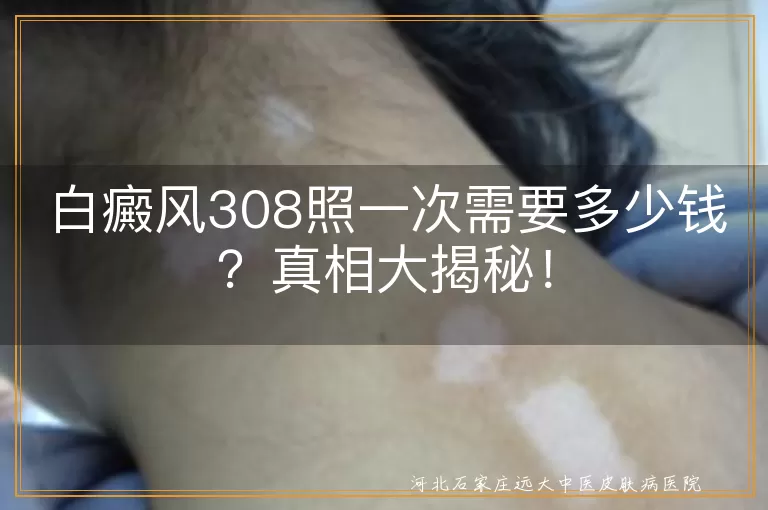 白癜风,308激光治疗,费用,治疗区域,医院等级,设备技术,病情严重程度