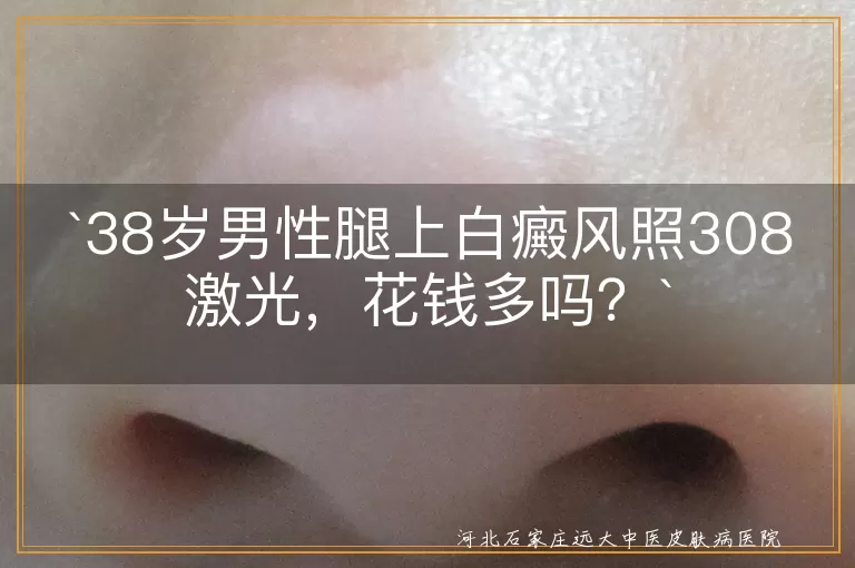 `308激光治疗,白癜风,治疗费用,地区差异,医院级别,病情严重程度,省钱窍门,心态重要性`