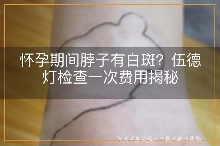 怀孕期间,白斑,伍德灯检查,费用,医院等级,地区差异,生活习惯,心态