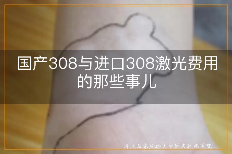 国产308激光,进口308激光,费用对比,治疗面积,病情严重程度,医院选择,性价比