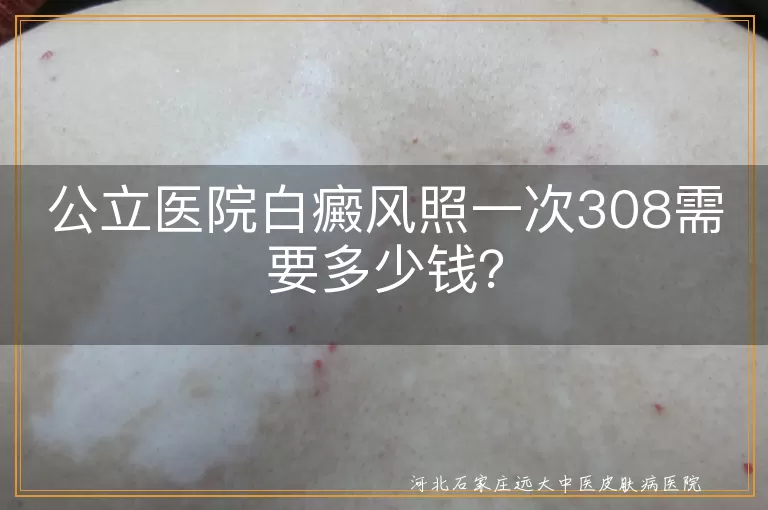 公立医院,白癜风,308激光治疗,费用,治疗效果,安全性