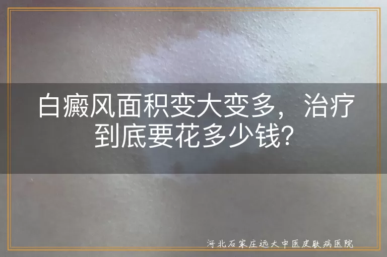 白癜风,治疗费用,病情严重程度,治疗方法,个人体质,医院选择,预防复发
