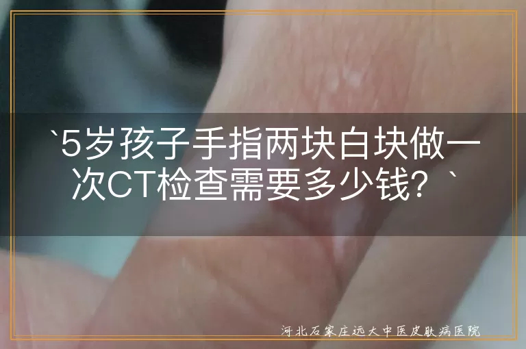 手指白块,CT检查,费用,医院等级,医保政策,检查项目