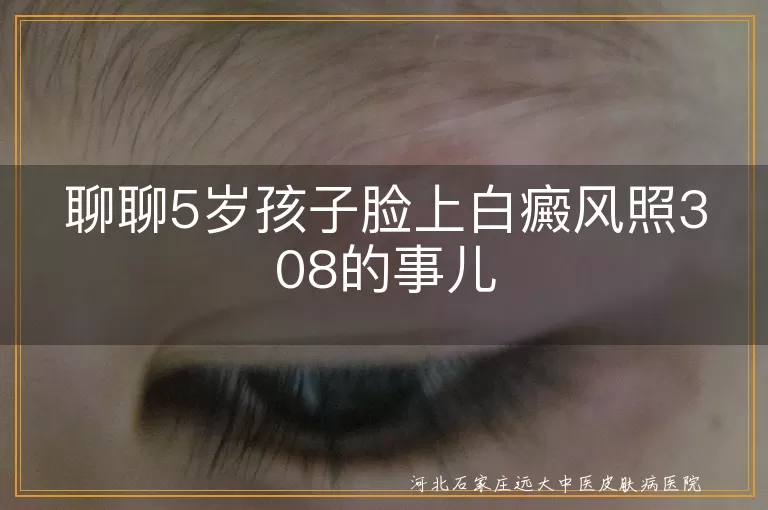 5岁孩子,白癜风,308准分子光治疗,费用,治疗效果,家长注意
