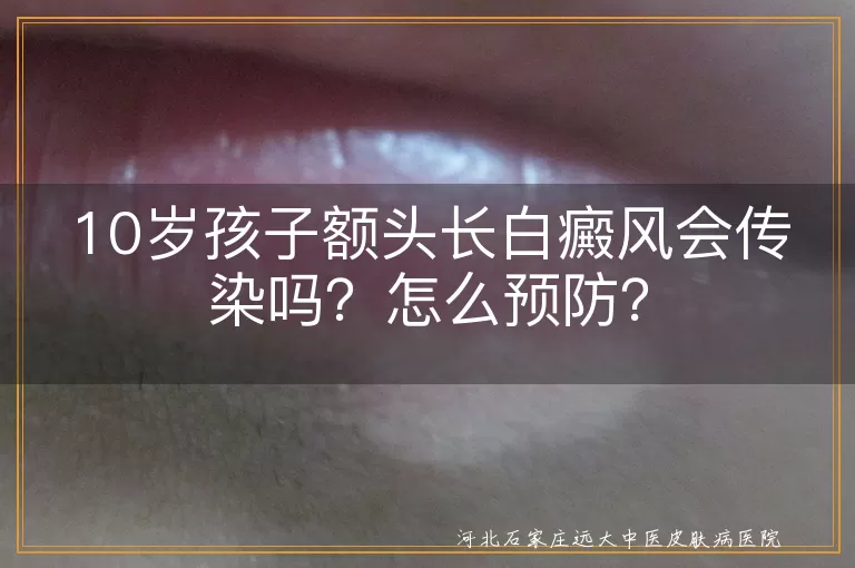 白癜风,传染性,预防,治疗,心理健康,生活习惯,合理饮食