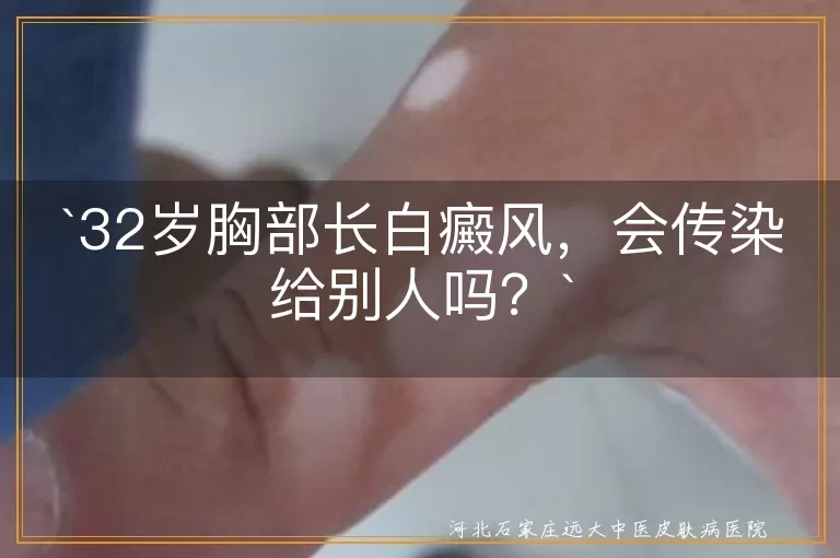 白癜风,传染性,黑色素细胞,病因,治疗,心态调整