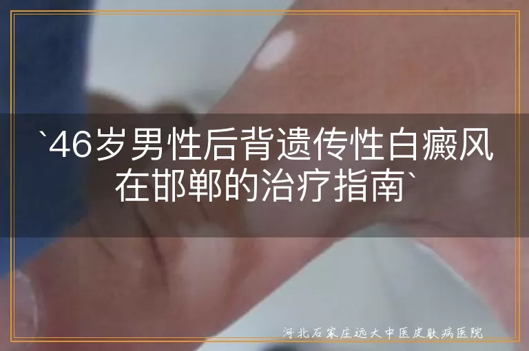 邯郸,遗传性白癜风,治疗,药物,光疗,手术,中医特色疗法,个体化方案,控制病情
