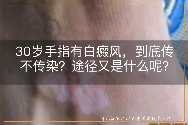 白癜风,不传染,遗传,自身免疫,精神因素,治疗,防晒,心态调整