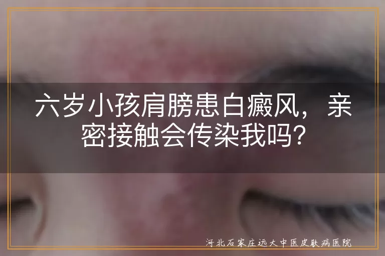 白癜风,传染病,亲密接触,治疗,关爱,支持,心态