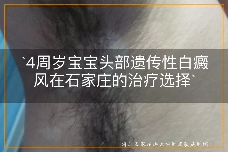石家庄,白癜风,遗传性,儿童,治疗方法,308准分子激光,中医脐疗,护理保健