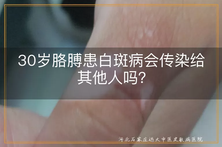 白斑病,白癜风,传染,预防,治疗