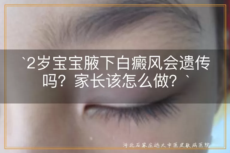 白癜风,遗传,2岁宝宝,及时就医,合理治疗,生活护理,心理关怀
