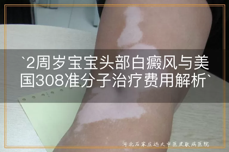 白癜风,2周岁宝宝,美国308准分子激光,治疗费用,日常护理