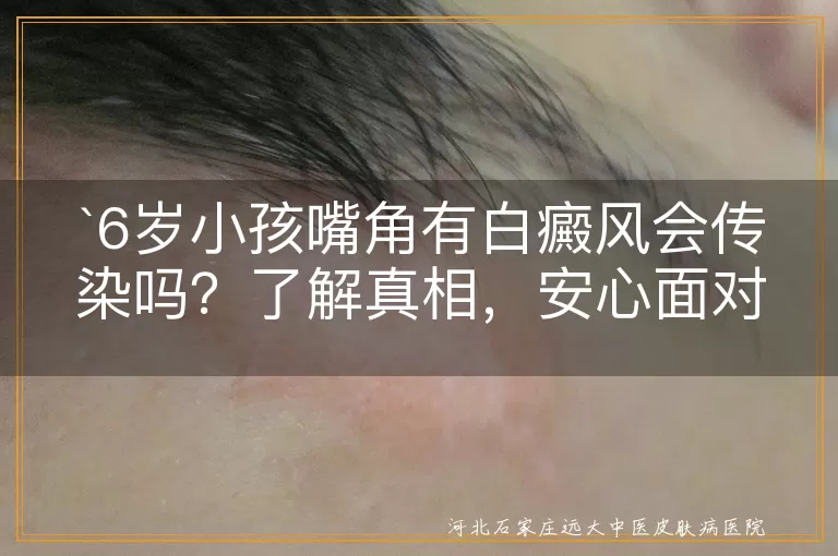 白癜风,传染,儿童,非传染性,治疗,心理支持