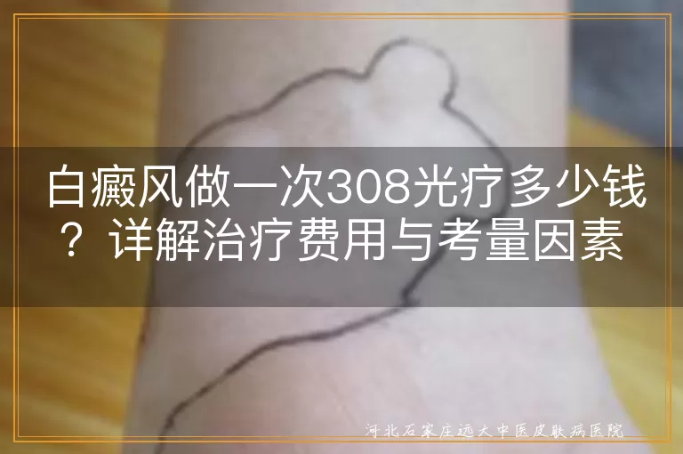 白癜风,308光疗,治疗费用,医院级别,治疗次数,疗程,影响因素