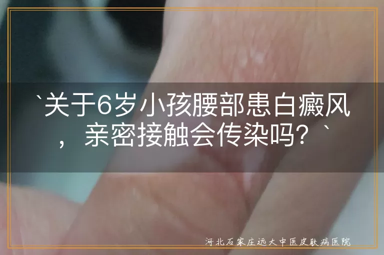 白癜风,亲密接触,传染,心理支持,科学治疗,遗传性