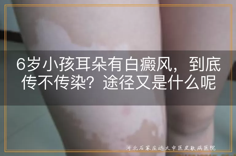 白癜风,传染性,传播途径,儿童,预防,日常护理