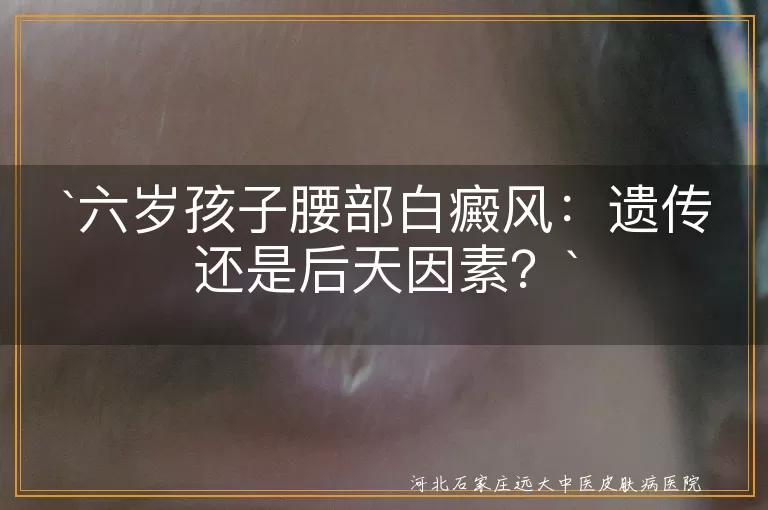 白癜风,遗传因素,后天因素,免疫系统异常,外伤,精神压力,环境因素,生活习惯,感染,科学治疗
