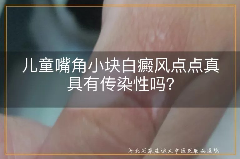 儿童白癜风,传染性,治疗,日常护理,心理关怀