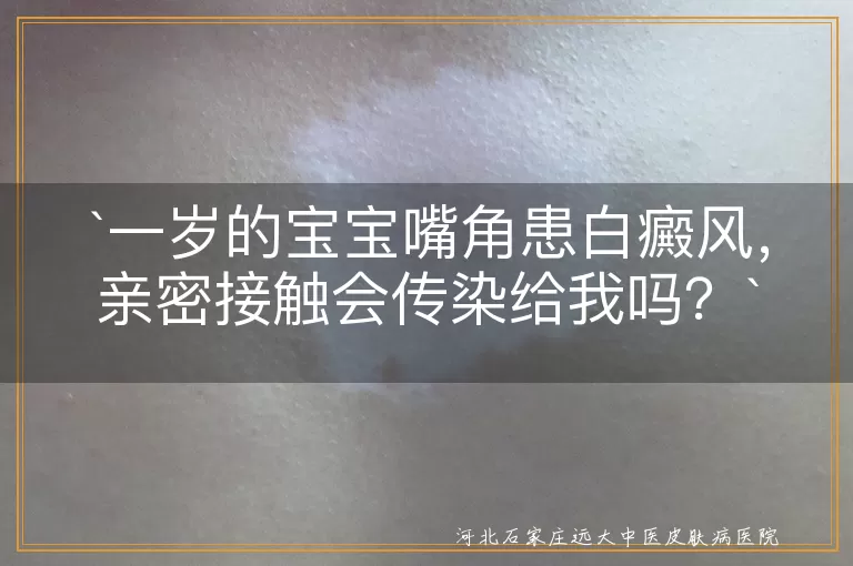 白癜风,亲密接触,传染,病因,治疗,预防,护理