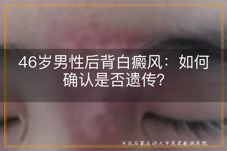 白癜风,遗传,家族史,专业检查,基因检测,治疗,生活习惯,心态