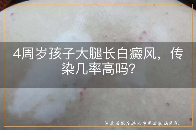 白癜风,传染,4周岁孩子,大腿,遗传因素,自身免疫系统疾病,精神因素,治疗,日常护理,心理疏导