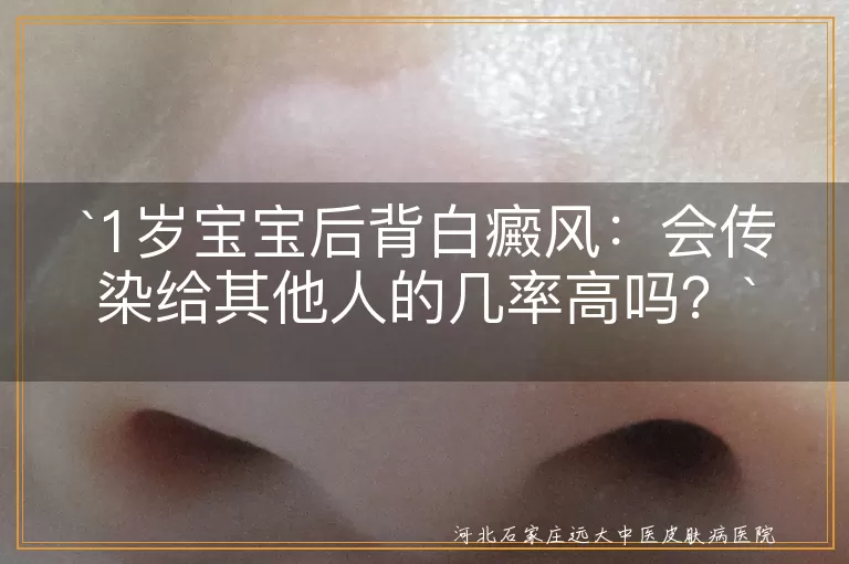 `白癜风,传染,宝宝,遗传因素,自身免疫,就医,日常护理,心理疏导`