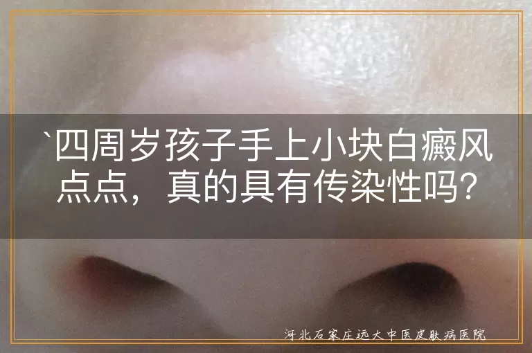 白癜风,传染性,儿童,治疗,家长,护理,心理健康