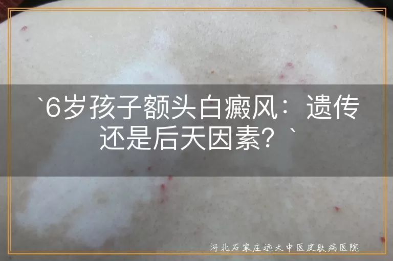白癜风,遗传因素,后天因素,儿童,治疗,预防