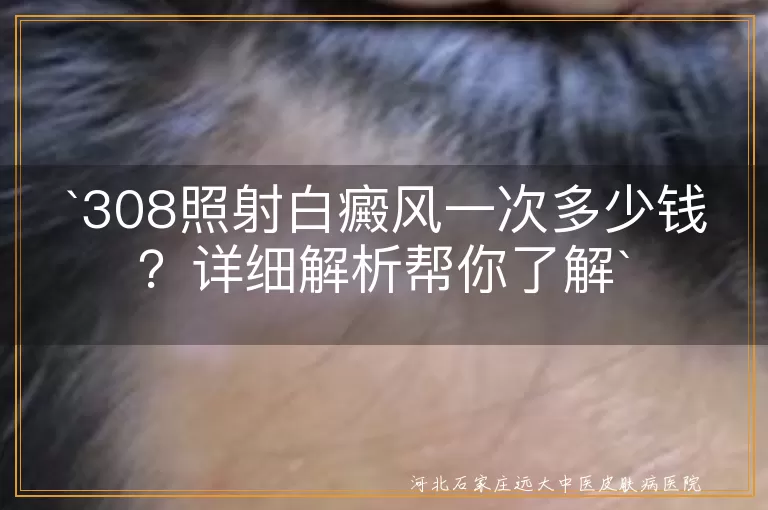 308照射,白癜风,费用,影响因素,治疗周期,正规医院,医保政策,防晒措施