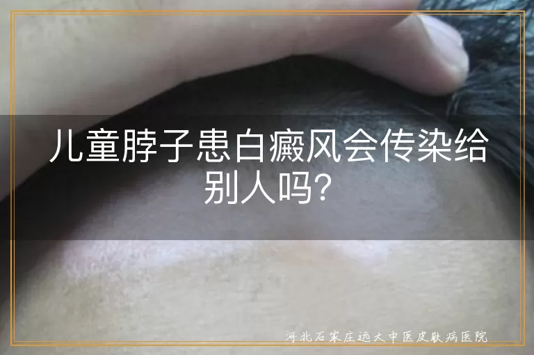 儿童白癜风,非传染性,自身免疫性疾病,遗传因素,免疫功能紊乱,心理健康,治疗方法