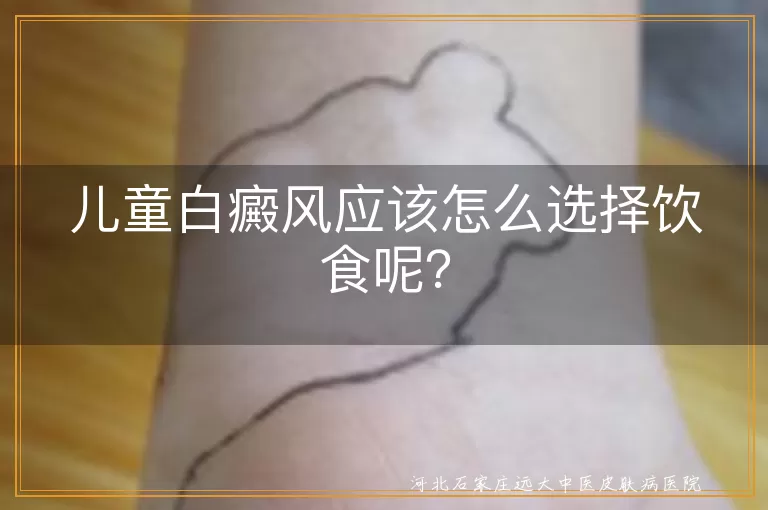 儿童白癜风应该怎么选择饮食呢？